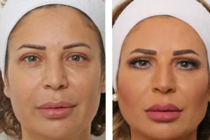 هل شد الوجه في دبي هو الخيار الأمثل لتجديد شبابك؟
